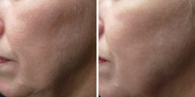 before-after-02
