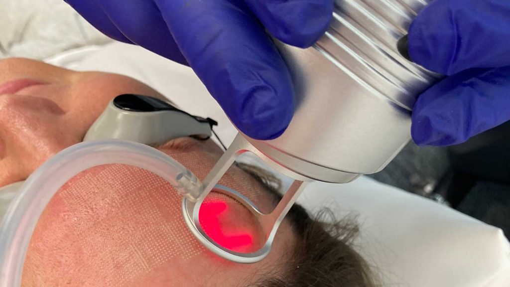 How does CO2 Laser work?