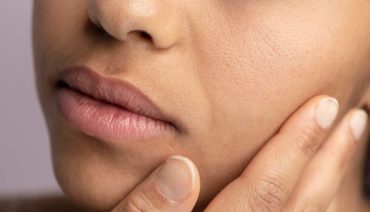 CO2 Treatment Recovery Tips